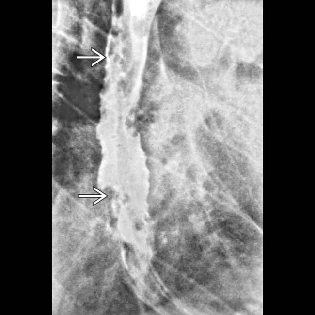 esophageal varices x ray