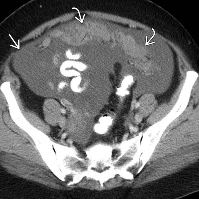 Abdominal CT: peritoneal cavity • LITFL • Radiology Library