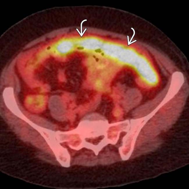 An unusual cause of “omental cake” in CT: peritoneal tuberculosis | Eurorad