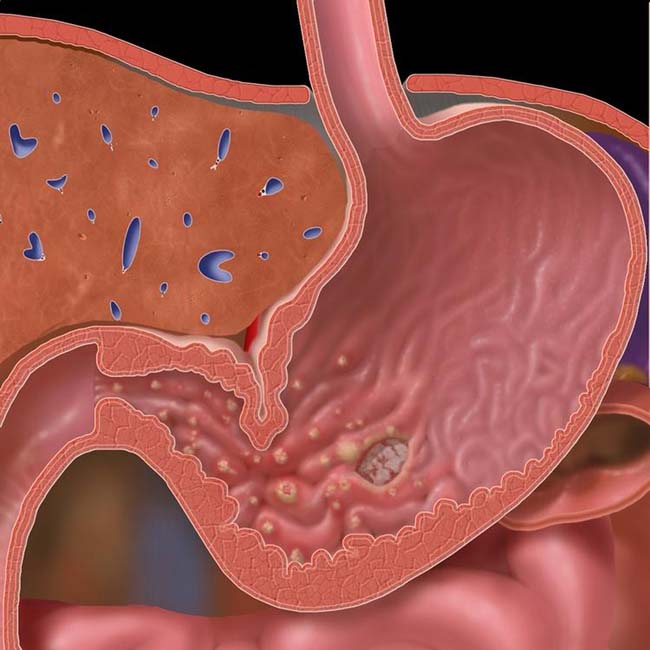 Gastritis Radiology Key.