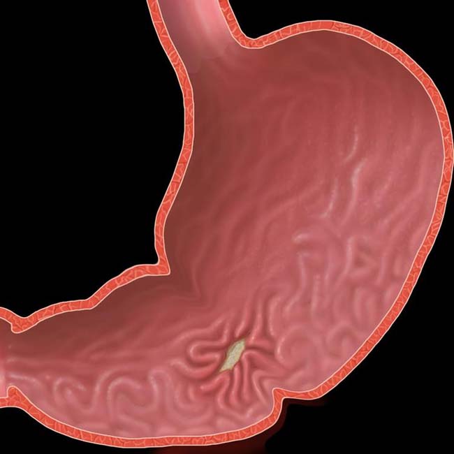 What Is Gastric Ulcer