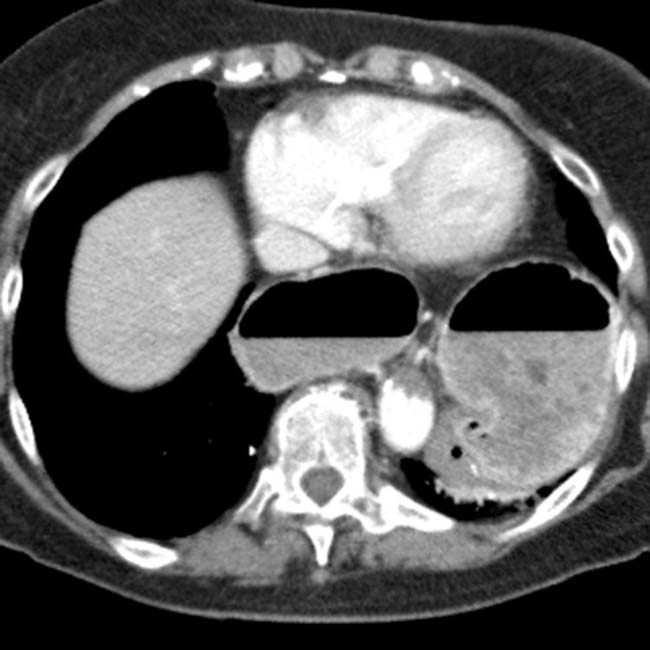 Paraesophageal Hernia With Gastric Volvulus