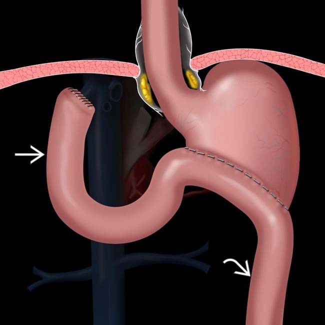 partial gastrectomy