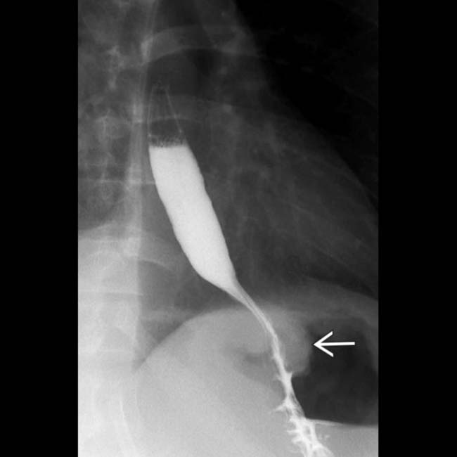 fundoplication-complications-radiology-key