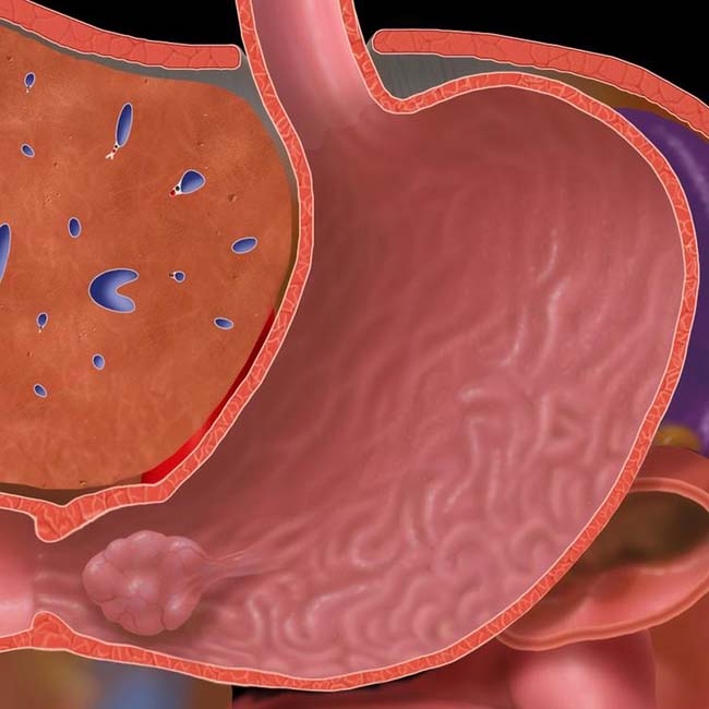 gastric-polyps-radiology-key