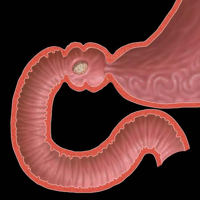 Perforated Duodenal Ulcer