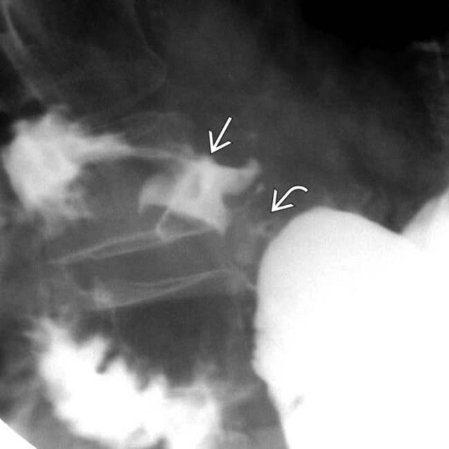 duodenal ulcer x ray