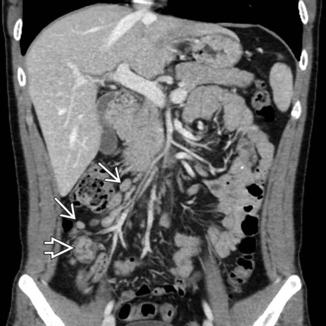 solution-to-unknown-case-21-mesenteric-lymphadenopathy-differential