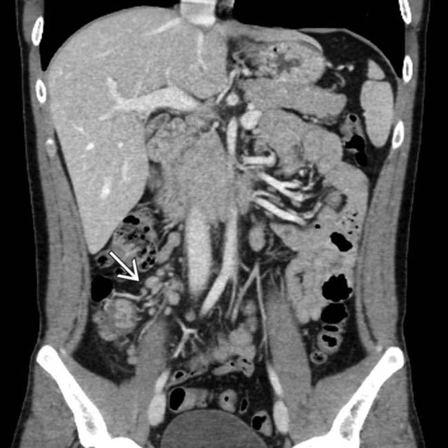 pdf-non-specific-mesenteric-lymphadenitis-and-cervical