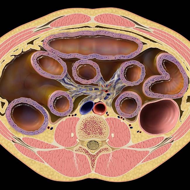 Ischemic Enteritis Radiology Key 0341