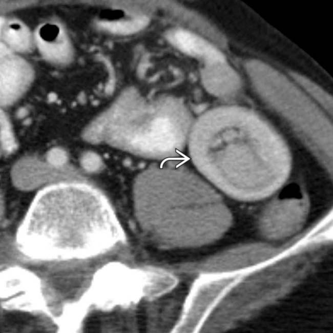 Intestinal Metastases and Lymphoma | Radiology Key