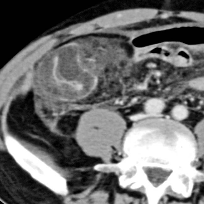 Neutropenic Colitis Typhlitis Radiology Key