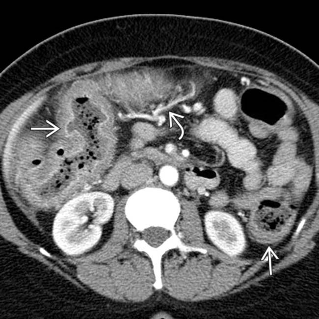 Ulcerative colitis, Radiology Reference Article
