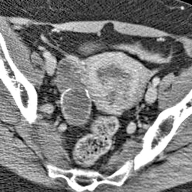 Mucocele Of The Appendix Radiology Key