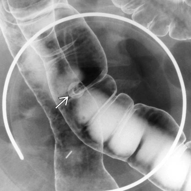 double-contrast-barium-enema-stop-colon-cancer-now