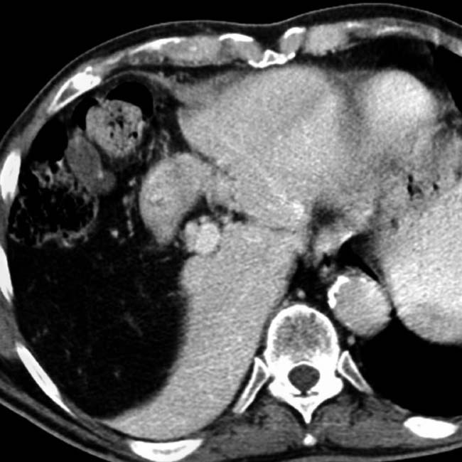 Congenital Absence Of Hepatic Segments | Radiology Key