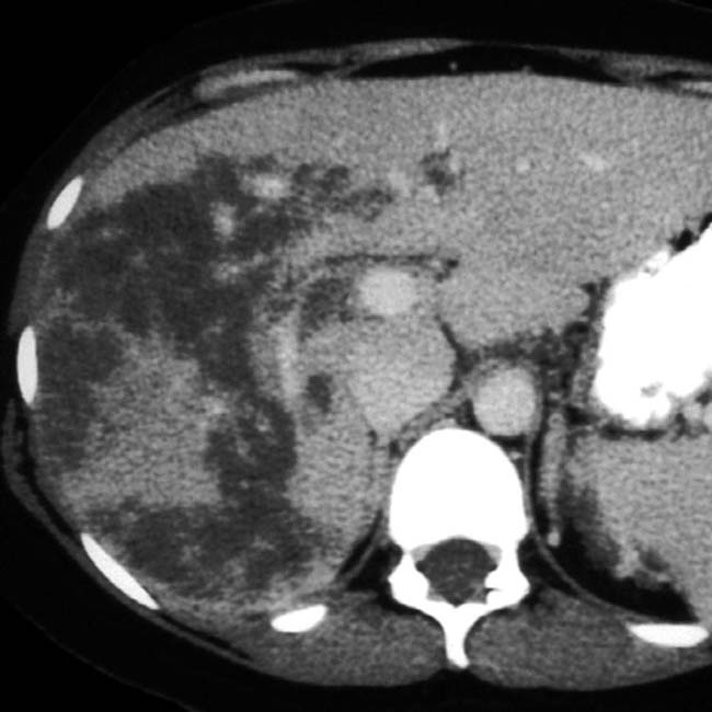 HELLP Syndrome Radiology Key