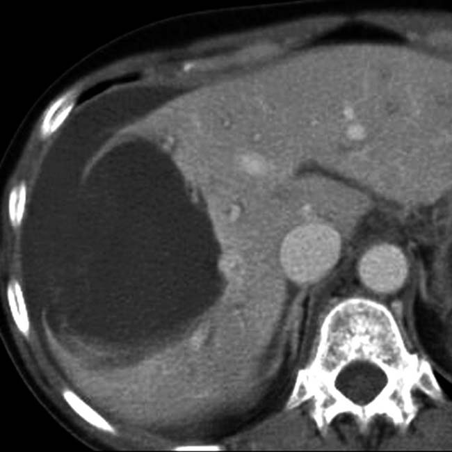 Hepatic Cyst