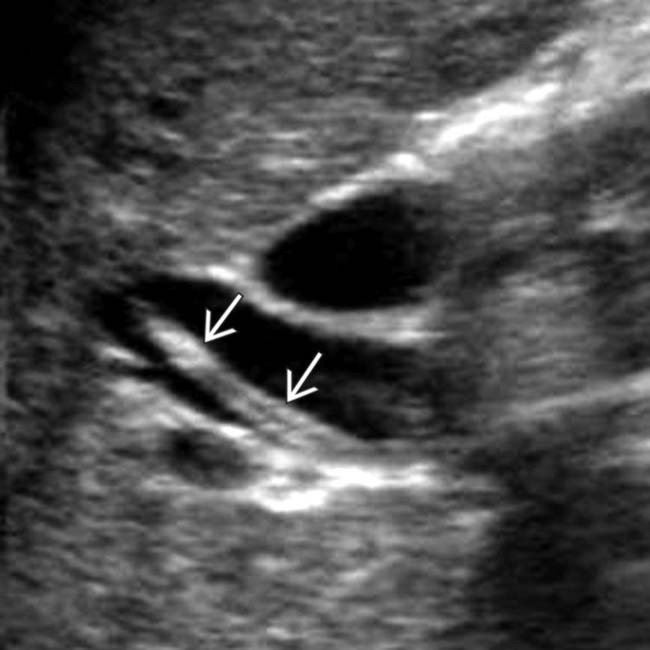 Pancreatobiliary Parasites | Radiology Key