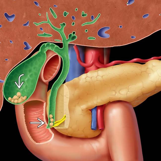 gallstones-and-sludge-radiology-key