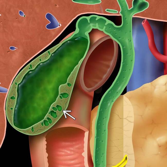 Hyperplastic Cholecystoses | Radiology Key