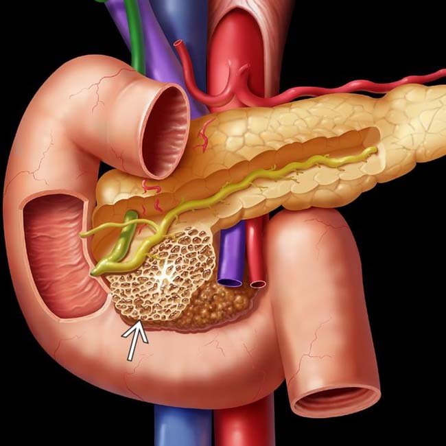 serous-cystadenoma-pancreas