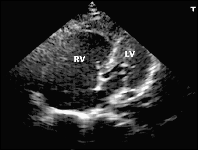 Hennepin Ultrasound  Right Ventricular Strain in Pulmonary Embolism