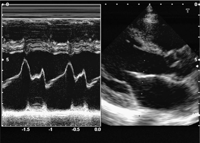 Hennepin Ultrasound  Right Ventricular Strain in Pulmonary Embolism