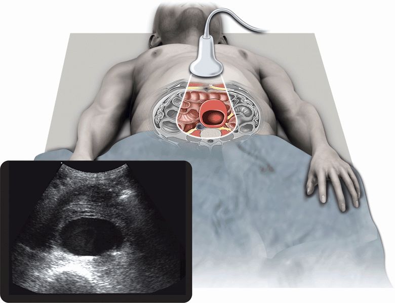 ruptured abdominal aortic aneurysm ultrasound
