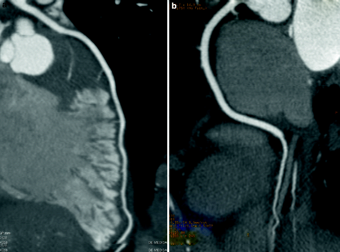 Coronary Atherosclerosis Imaging by Coronary CT Angiography