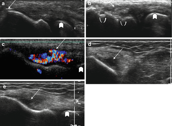 Muscle Injury  Radiology Key