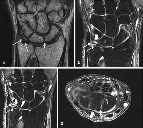 ulnar collateral ligament wrist mri