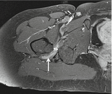 bursa hip mri