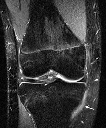 Radiologic Imaging of Knee Injuries | Radiology Key