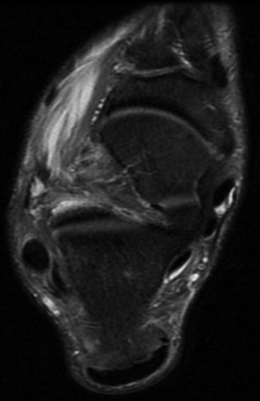 Radiological Imaging of Foot Injuries | Radiology Key