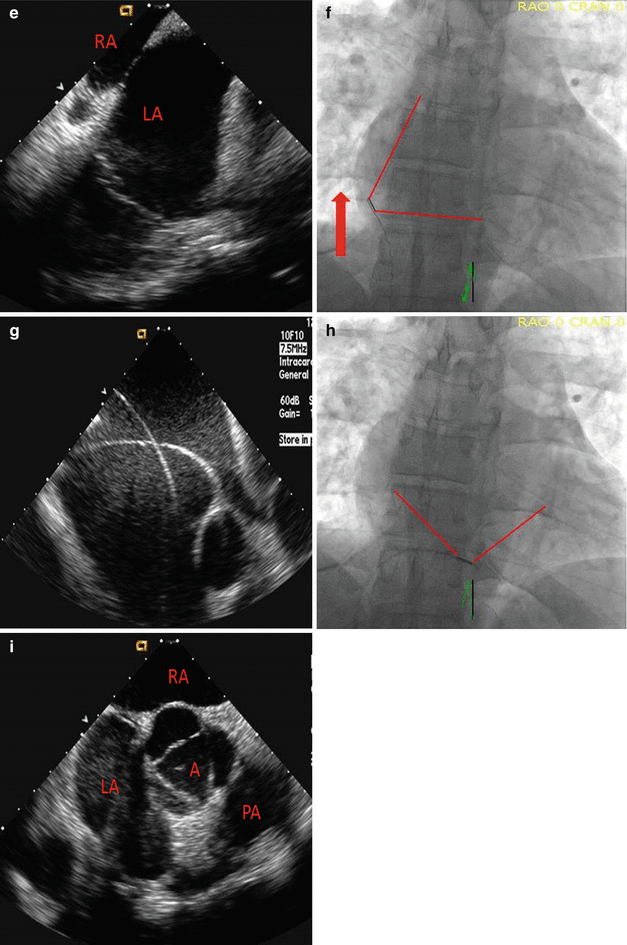 Intra-cardiac Echocardiography-Guided Interventional Imaging ...