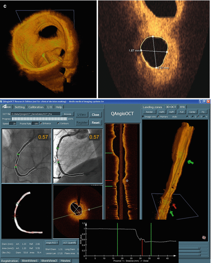 Optical Coherence Tomography - Radiology Key