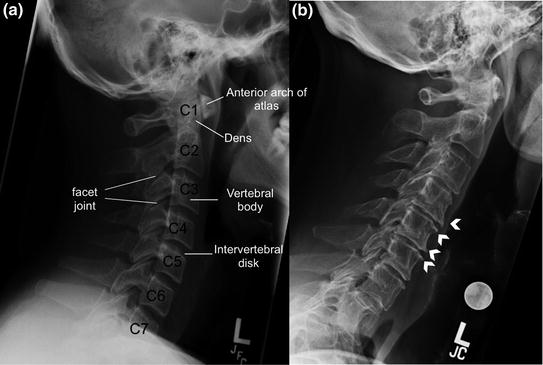 x ray cervical spine ap lateral