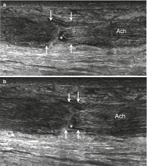 Imaging of Golf and Racquet Injuries | Radiology Key