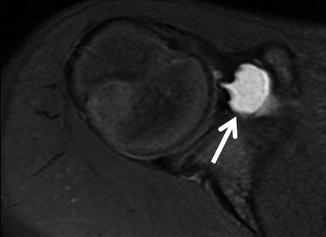 A teenage asymptomatic male swimmer. Prefemoral fat pad edema and