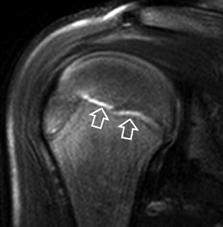 A teenage asymptomatic male swimmer. Prefemoral fat pad edema and