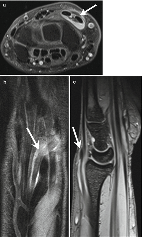 intersection syndrome radiology a bal térdízület artrózisa 3 fok