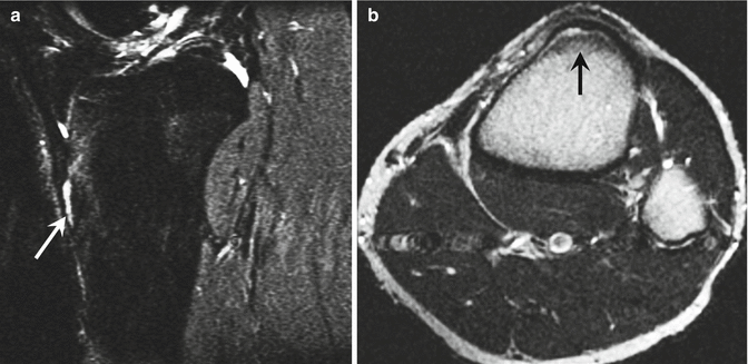 Imaging Of Weight-lifting Injuries 