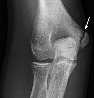 Pediatric Considerations in Sports-Specific Injuries | Radiology Key