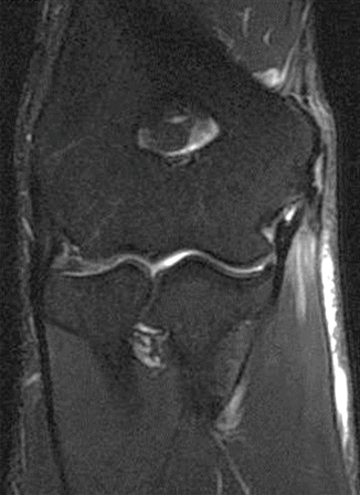 Imaging of Handball Injuries | Radiology Key