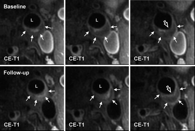 Imaging Of Carotid Atherosclerosis Radiology Key