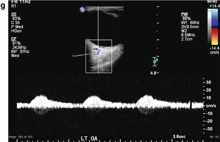 Essentials of Transcranial Doppler Ultrasound | Radiology Key