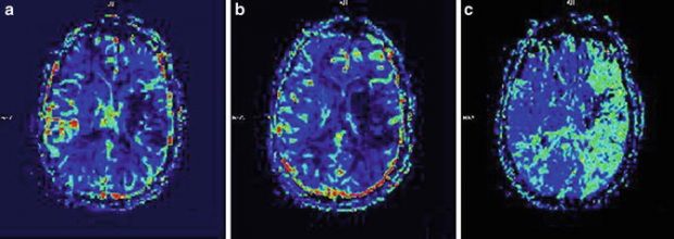 Territorial Strokes as a Tool to Learn Vascular Territories | Radiology Key