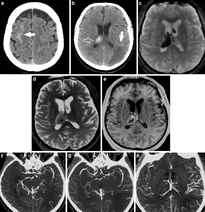 imaging-of-spontaneous-nontraumatic-intracerebral-hemorrhage