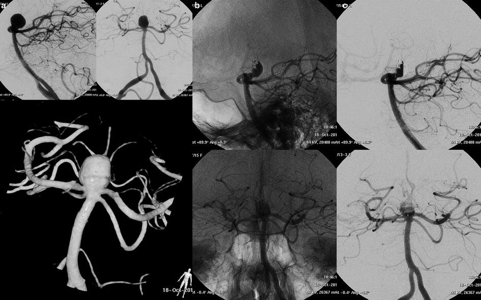 Endovascular Treatment Of Brain Aneurysms | Radiology Key